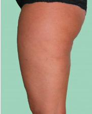 Masderm Anti-Cellulite Treatment  The professional anti-cellulite