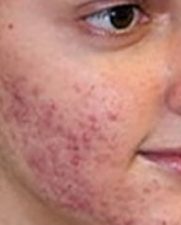 acne_before
