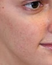 after-acne-serum