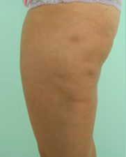 cellulitebefore