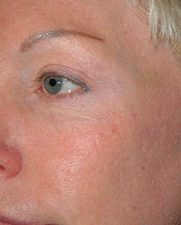 rosacea-after-300x300