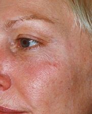 rosacea-before-300x300