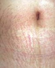 stretchmark1