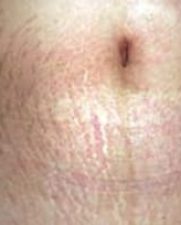 stretchmark1