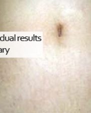 stretchmark2